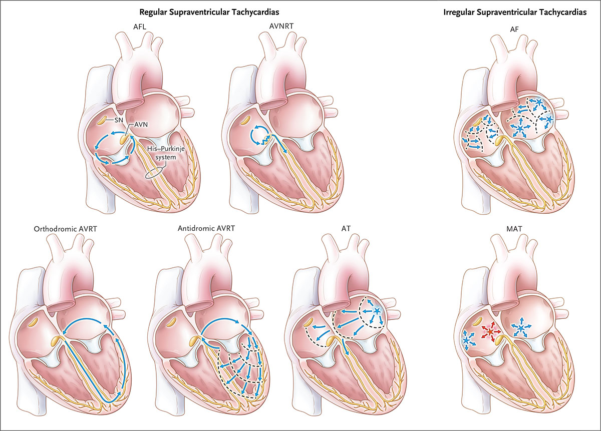 心房扑动(afl,房室结折返性心动过速(avnrt,房室交互性心动过速