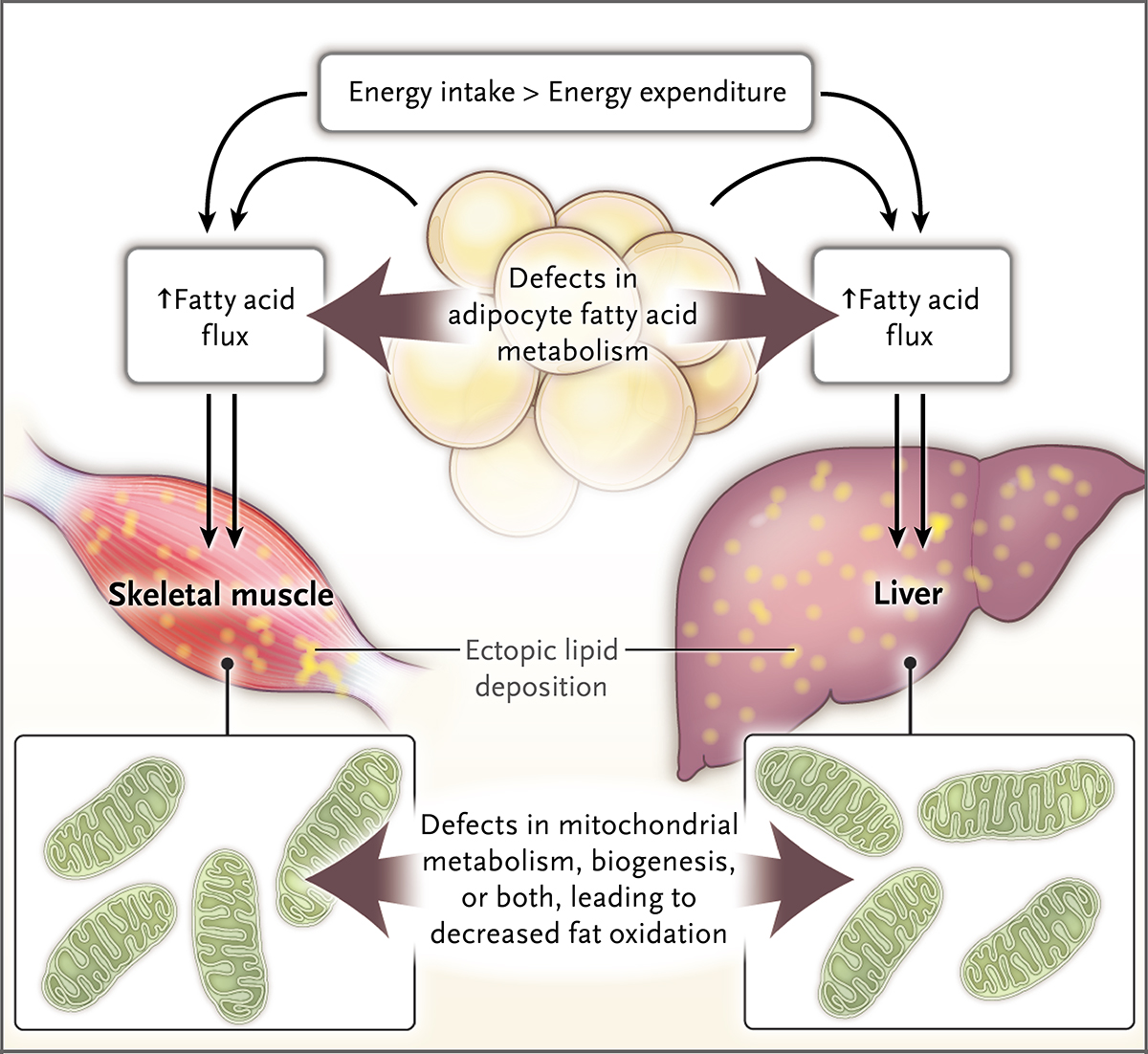 3 肝脏和骨骼肌内异位脂质沉积增多的机制