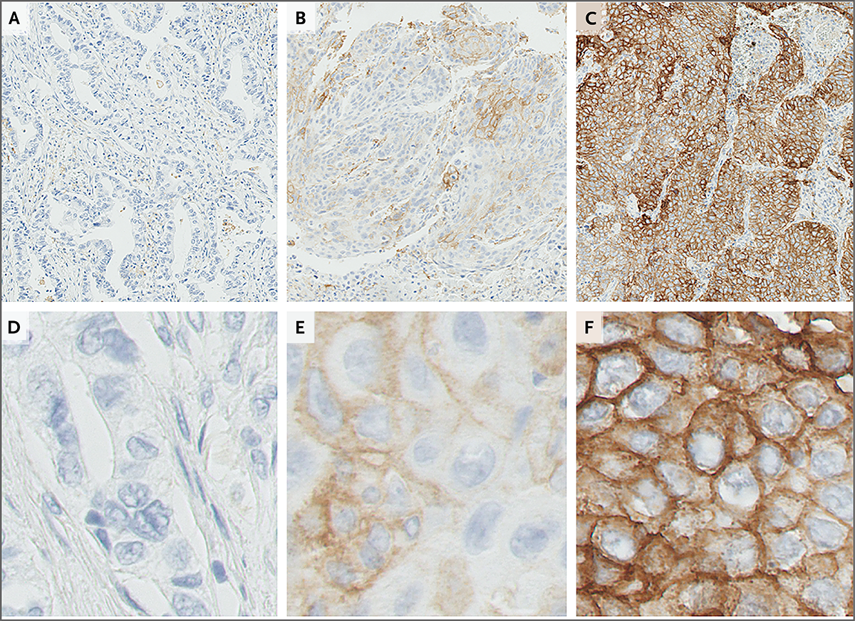 Pembrolizumab治疗非小细胞肺癌的研究 Nejm医学前沿