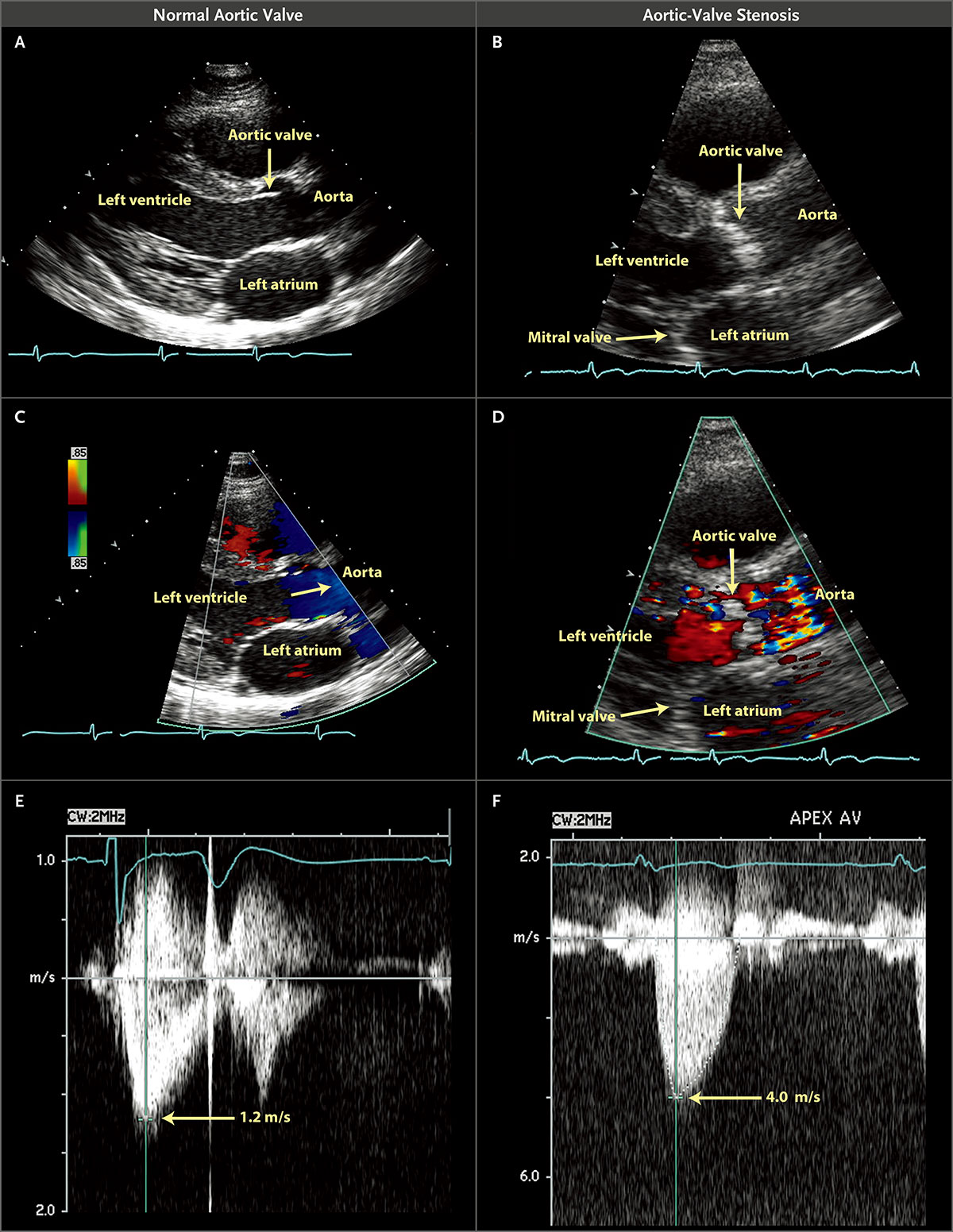 1 主动脉瓣狭窄的超声心动图评估