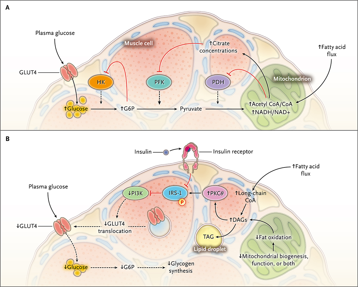 1. 肌肉内脂质诱发胰岛素抵抗的分子机制