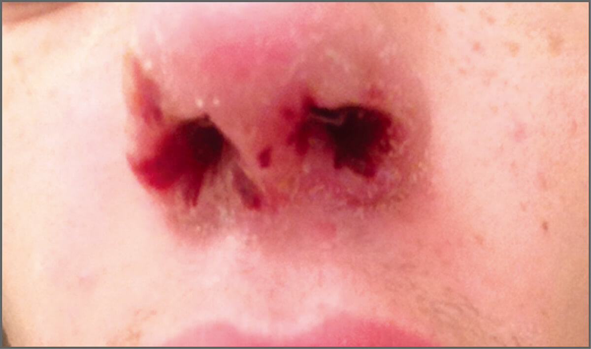 鼻粘膜溃疡的症状图片图片