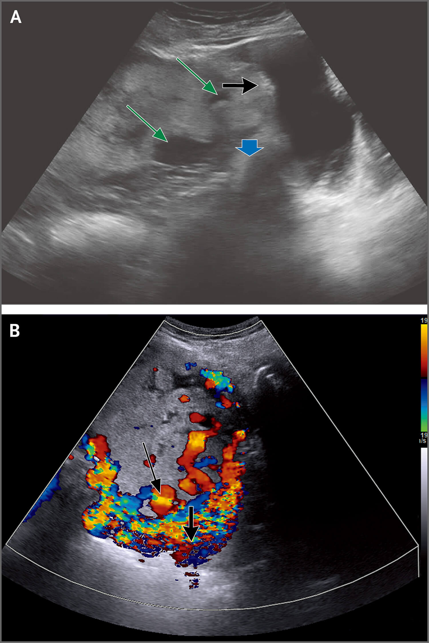 灰阶超声影像显示前置胎盘(蓝色箭形),多个血管腔隙(绿色箭形)和子宫