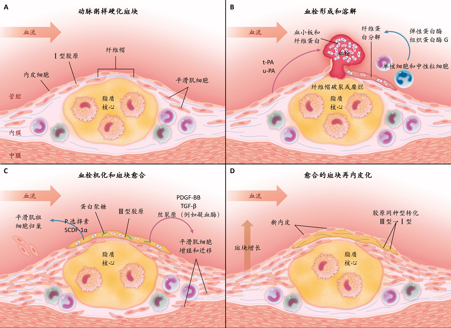 动脉粥样硬化斑块的愈合 Nejm医学前沿