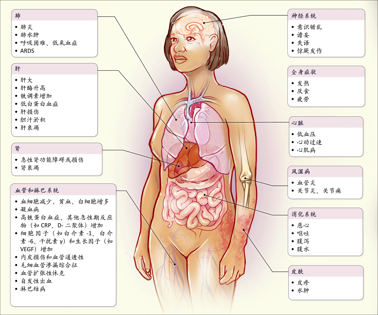 细胞因子风暴 Nejm医学前沿